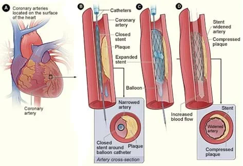 Cut-away diagram shows an expanding balloon and metal mesh stent, entering, pushing out on the walls, and leaving the stent in an artery.