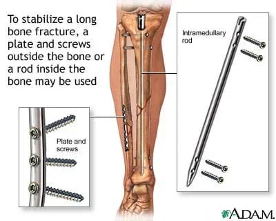 Cutaway medical illustration shows repaired fibula and tibia with plate and screws, and intramedullary rod and screws.