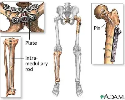 Drawing shows a human skeleton of pelvis, legs and feet with three locations containing bone repair using a pin, plate and intramedullary rod.