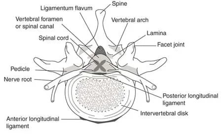 A cross-section drawing of the human spine identifies its structures: ligamentum flavum, spine, vertebral arch, facet joint, posterior longitudinal ligament, intervertebral disk, anterior longitudinal ligament, nerve root, pedicle, spinal cord and vertebral foramen (or spinal canal).