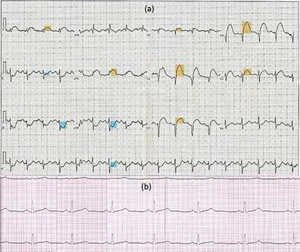 The ECG of an arrhythmic heart and the ECG of a healthy heart.