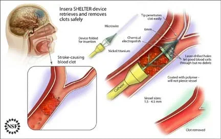 A diagram with medical images shows a stroke-causing blood clot and how the Insera SHELTER device retrieves and removes blood clots safely by inserting a long, narrow, pointed device into a human brain's blood vessel. The device is made of nickel and titanium with a chemical electropolish coated with polymer (will not pierce vessel) and a microwire tip, and is folded for insertion. Vessel sizes: 1.5–4.5 mm. The tip penetrates the clot easily. Laser-drilled holes let good blood cells through, but no debris.