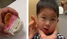 (top) A hand on the left holds an ear that has been 3D printed for a patient, on the right the ear is being held next to the patients head as if about to put it on.