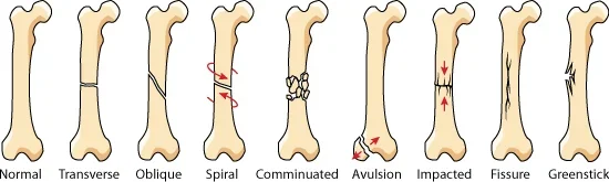 A drawing shows a normal long-shaped bone and eight similar bones, each with markings indicating different types of fractures: transverse, oblique, spiral, comminuated, avulsion, impacted, fissure, greenstick.