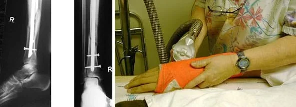 Two photographs. An x-ray shows two views of a person's right foot, ankle and shin (distal portion of a fractured tibia) with an internal rod and screws in place. A person uses a hand-sized saw to cut through the rigid cast on another person's right hand arm from mid palm to forearm.