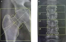 Two black and white x-ray images. A dual-energy x-ray absorptiometry (DEXA) assessment of bone mineral density of the femoral neck (A) and the lumbar spine (B): T scores of - 4.2 and - 4.3 were found at the hip (A) and lumbar spine (B), respectively in a 53 year-old male patient affected with Fabry disease.