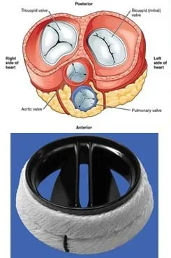 Two images: A cross-section drawing of the heart with the four heart valves identified: tricuspid, bicuspid/mitral, aortic and pulmonary. A photograph of an example engineered artificial heart valve, an Aortic Karboniks-1 bileafter prosthetic heart valve, which looks somewhat like a black plastic top to a coffee cup with finned openings, surrounded by a softer white material.