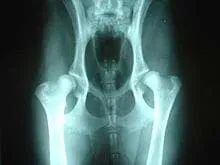 An x-ray showing someone with hip dysplasia.