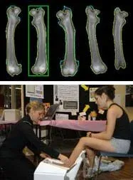Two images: An x-ray image shows five different angles of a long bone taken for a bone density medical scan. A photograph shows a woman performing a bone density test by placing the foot of a nearby seated woman into a box-shaped machine on the floor.