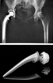 Two images: A black and white x-ray shows a human pelvis with a total hip joint replacement—an artificial "ball and socket" joint. A stainless steel and ultra-high molecular weight polythene hip replacement device, with one end shaped like a ball and the other tapering to a point.